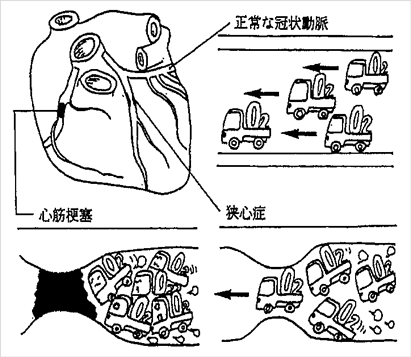 心筋梗塞の図